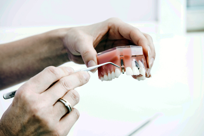 dentist holding a model of upper jaw with gold fillings
